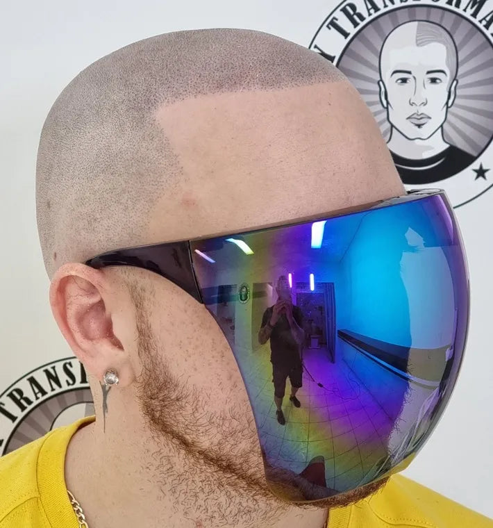 Scalp Micropigmentation Darch Perth Wa