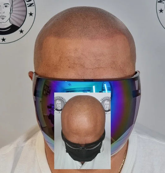 Scalp Micropigmentation Client Brabham Perth Wa