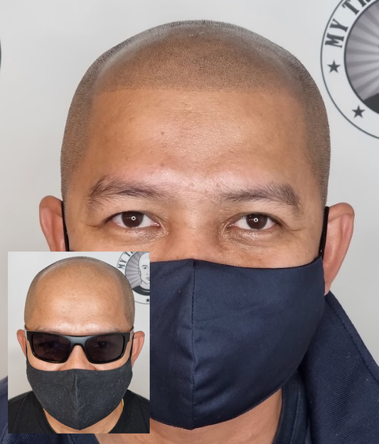 Hair Loss Treatment in Perth Wa