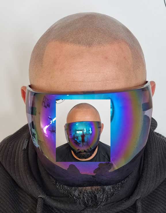 Scalp Micropigmentation Rivervale Perth Wa