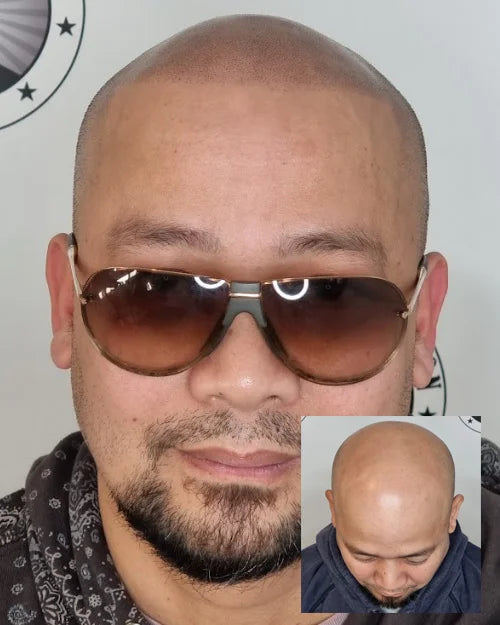 Scalp Micropigmentation Carlisle Perth Wa