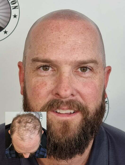 Scalp Micropigmentation Client Warwick Perth Wa