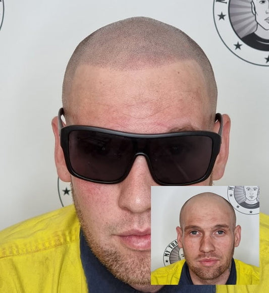 Scalp Micropigmentation Beeliar Perth Wa