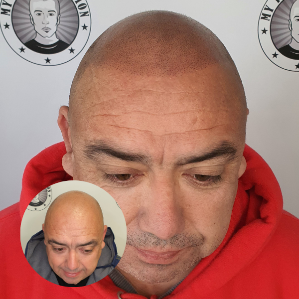 Hair tattoo Client Baldivis Perth Wa