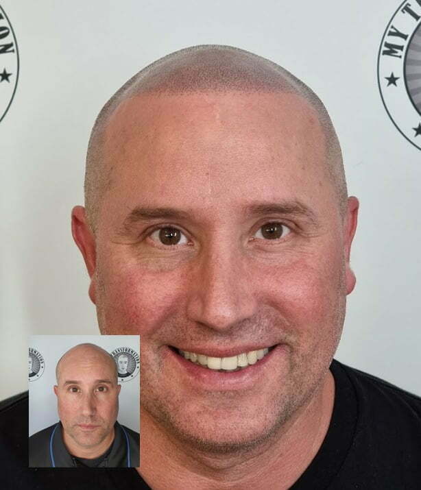 Scalp Micropigmentation Mirrabooka Perth Wa