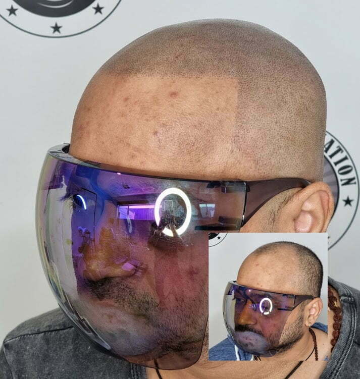 Scalp Micropigmentation Wanneroo Perth Wa