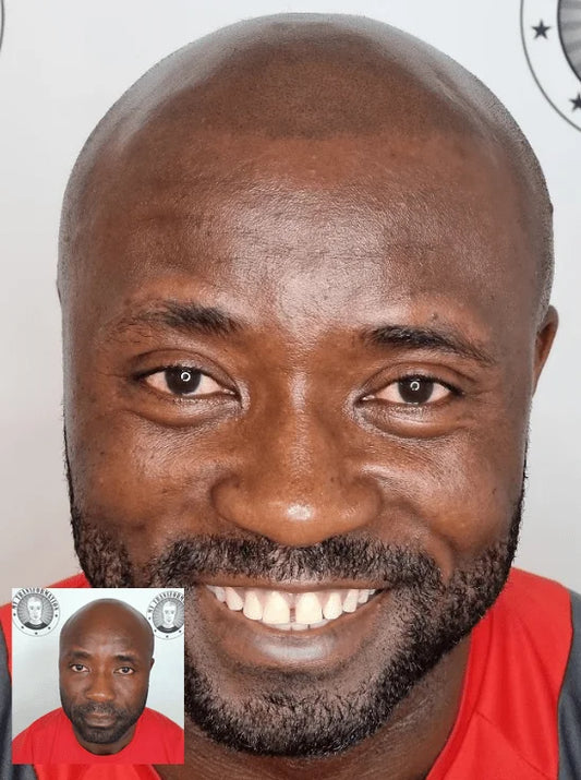 Scalp Micropigmentation Baldivis Perth Wa