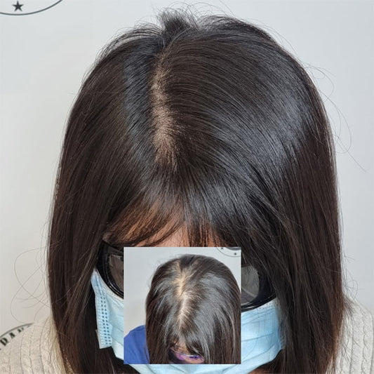 Scalp Micropigmentation Thornlie Perth Wa