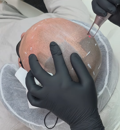 One Day SMP Session - Hair Tattoo