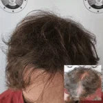 My Transformation, Scalp Micropigmentation Perth, Hair Tattoo Perth, SMP Perth, SMP WA, Perth Australia
