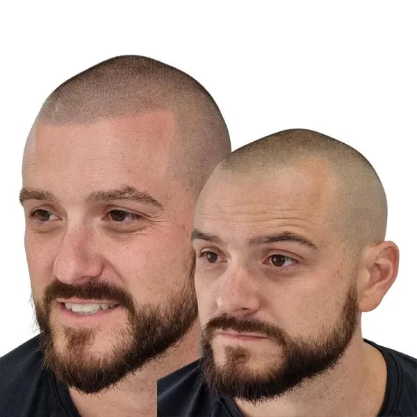 Hair tattoo for men with receeding hairline - If you are suffering from a receding hairline, then SMP can help.
If the recession of the hair is getting worse with hair thinning then shaving the head to zero and adding the hair tattoo fully would be a great option. If your receding hair is not to bad but the hairline is receding we can just reinstate the hairline but you would need to keep your hair at a one buzz cut for this too work. This allows you to keep the hair you have but increases the hairline.