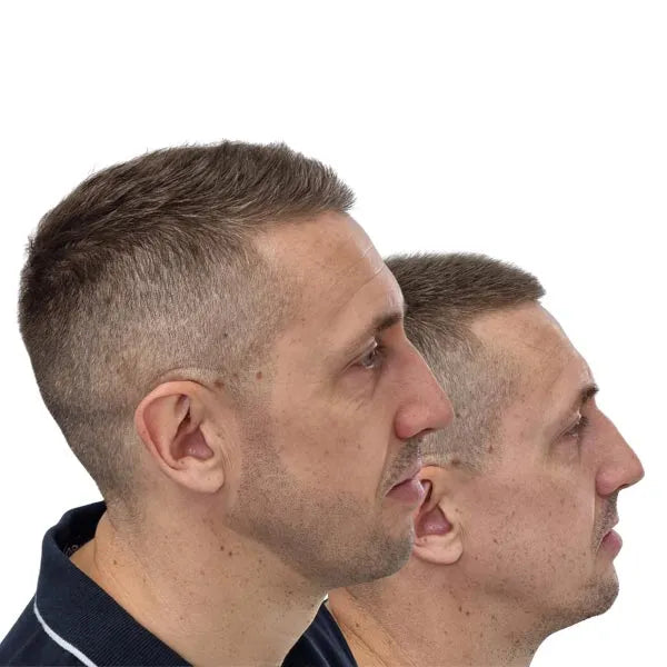 Beard Tattoo Perth Get the best-looking beard with Scalp Micropigmentation / Beard Tattoo the best way to combat patchy beards. Perth, WA, Australia.