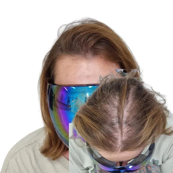 My Transformation | SMP | Hair Tattoo | Scalp micropigmentation | Scalp Micropigmentation Perth | Hairloss | Women's Thinning hair | Ballajura Perth WA