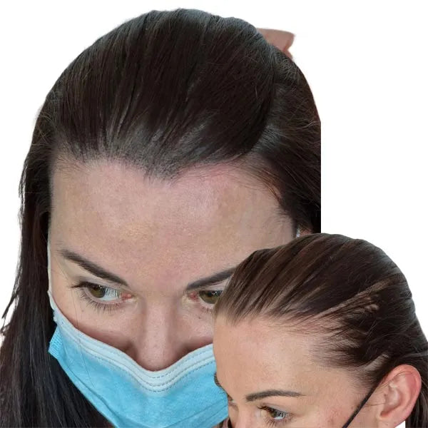 Hair Tattoo for Women - Regain your confidence back with Scalp Micropigmentation / Hair tattoo the best way to combat your hair loss. Perth, WA Australia.