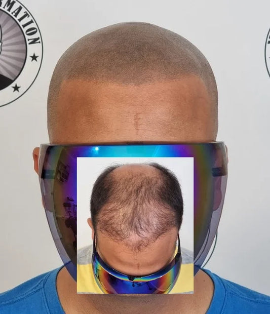 Scalp Micropigmentation Client Como Perth Wa