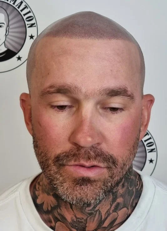 Scalp Micropigmentation Brabham Perth Wa