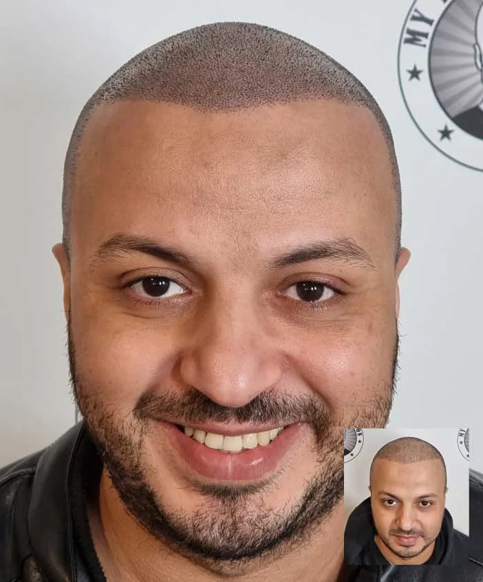 Scalp Micropigmentation For Hair Transplant