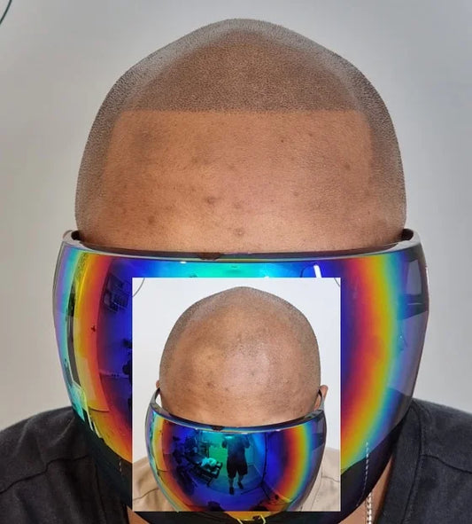 Scalp Micropigmentation Alexander Heights Perth Wa