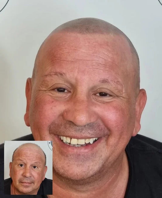 Scalp Micropigmentation Client Osbourne Park Perth Wa