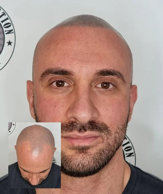 Scalp Micropigmentation Client Tuart Hill Perth Wa