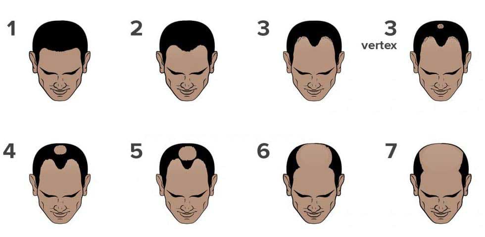 What Is The Norwood Scale?