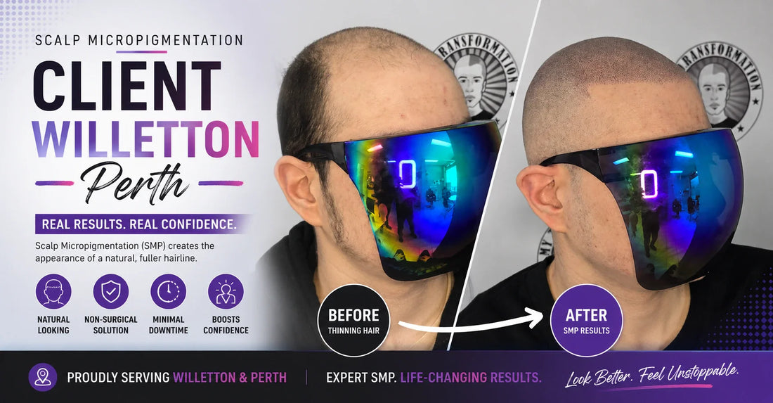Scalp Micropigmentation Client Willetton Perth
