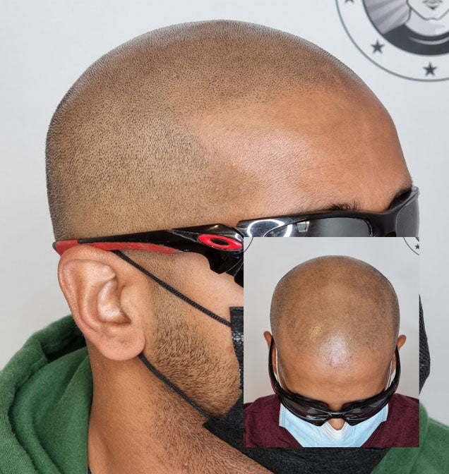 Hair Tattoo for Thinning Hair in Perth