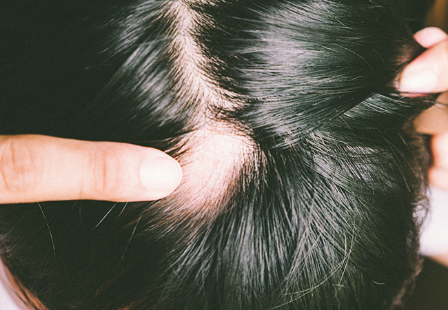 Scalp Micropigmentation For Alopecia perth Wa