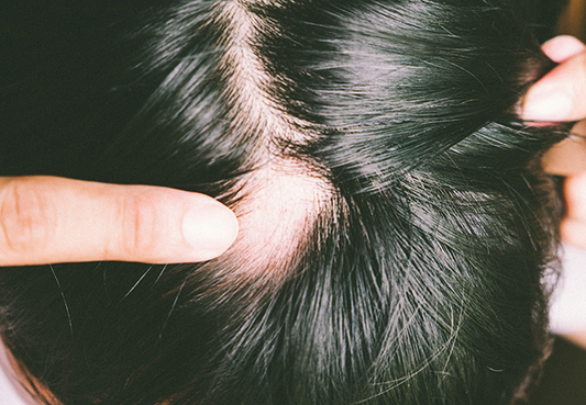 Scalp Micropigmentation For Alopecia perth Wa
