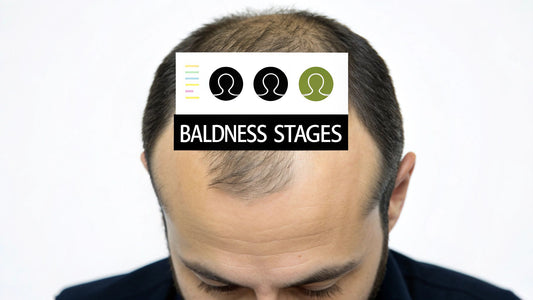 Your Guide to Male Pattern Baldness Stages