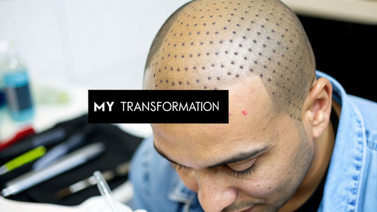 Male scalp micropigmentation Perth Australia My Transformation: A Guide
