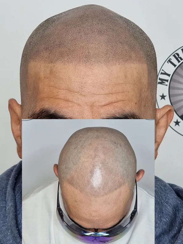 Micropigmentation