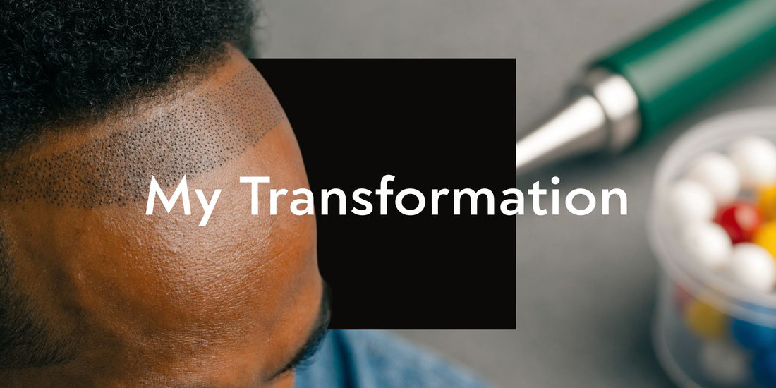 Scalp Micropigmentation Ellenbrook - My Transformation