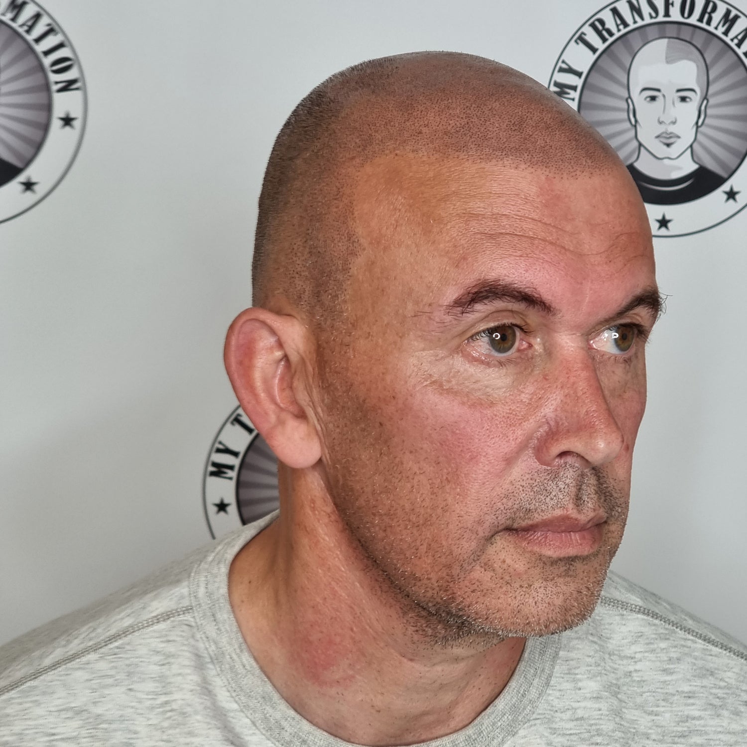 My Transformation, Scalp Micropigmentation Perth, Hair Tattoo Perth, SMP Perth, SMP WA, Perth Australia, Men's hair Tattoo, Session 2 Scalp Micropigmentation