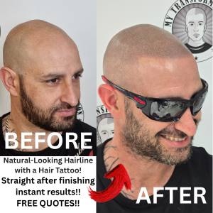 My Transformation, Scalp Micropigmentation Perth, Hair Tattoo Perth, SMP Perth, SMP WA, Perth, Australia, Men's hair Tattoo, SMP in action, Scalp Micropigmentation