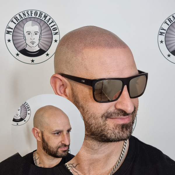 My Transformation, Scalp Micropigmentation Perth, Hair Tattoo Perth, MP Perth, SMP WA, Perth Australia