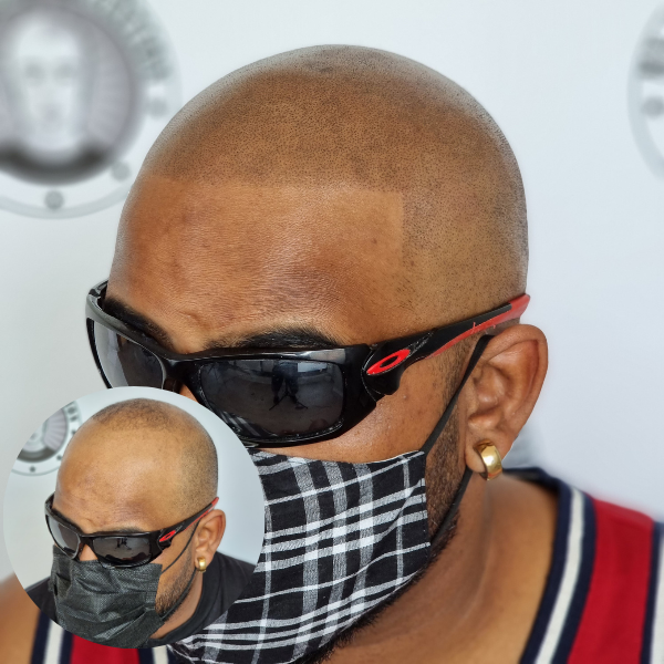 After SMP - scalp micropigmentation model result My Transformation Perth professional finish