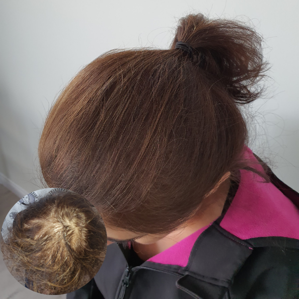 My Transformation,, Women's Hair Tattoo Perth, SMP Perth, SMP WA, Sclp Micropigmentation For Women , Hair Density For Women