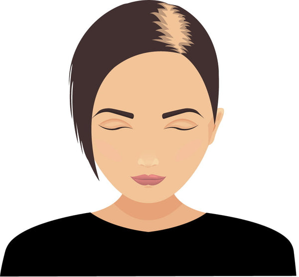 Female thinning hair solution SMP places tone between thinning hairs helping to reduce contrast Perth