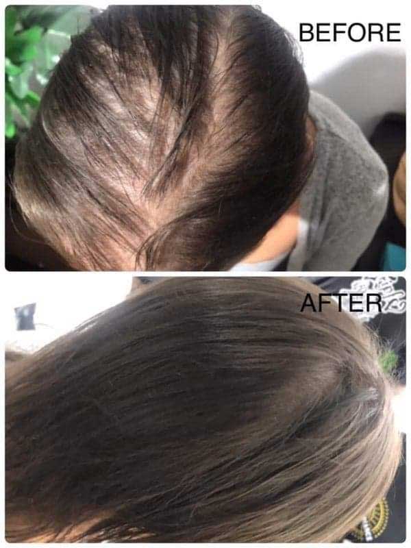 Female density SMP — My Transformation hair tattoo scalp micropigmentation Perth