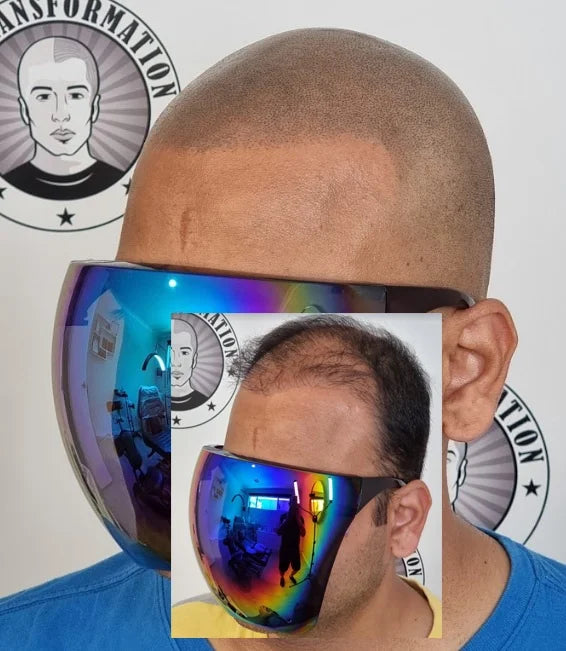 My Transformation, Scalp Micropigmentation Perth, Hair Tattoo Perth, MP Perth, SMP WA, Perth Australia