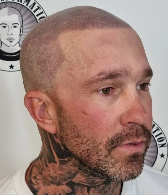 My Transformation, Scalp Micropigmentation Perth, Hair Tattoo Perth, MP Perth, SMP WA, Perth Australia