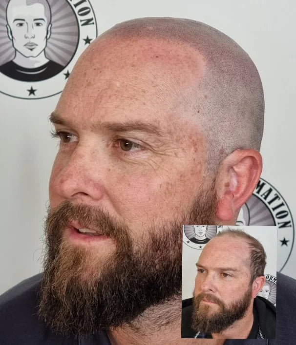 My Transformation, Scalp Micropigmentation Perth, Hair Tattoo Perth, MP Perth, SMP WA, Perth Australia