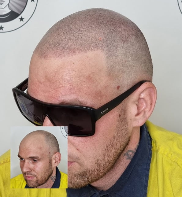SMP scar camouflage treatment Perth — My Transformation