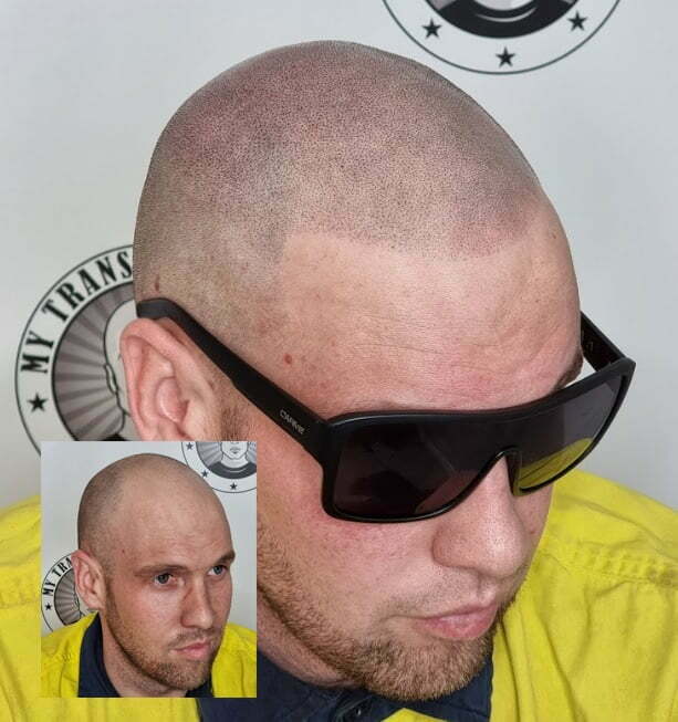 SMP for hair transplant scar camouflage Perth — My Transformation