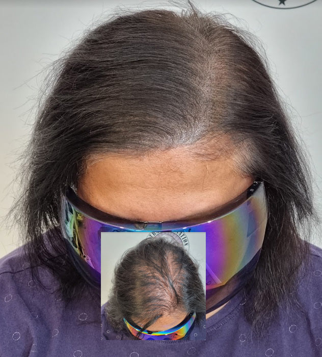 My Transformation, Scalp Micropigmentation Perth, Women's Hair Tattoo Perth, SMP Perth, SMP WA, Perth Australia