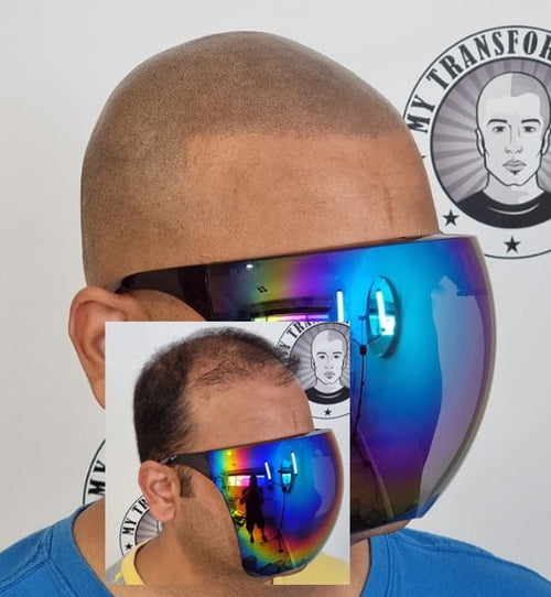 Scalp Micropigmentation final result — My Transformation Perth