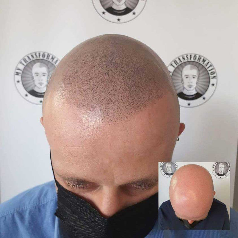 What is Scalp Micropigmentation SMP — My Transformation Perth hair tattoo result