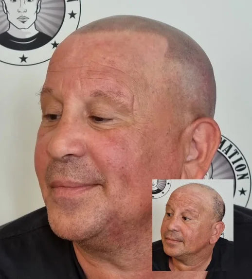 My Transformation, Scalp Micropigmentation Perth, Hair Tattoo Perth, MP Perth, SMP WA, Perth Australia