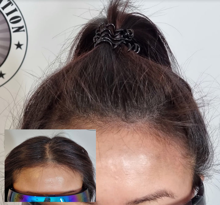 My Transformation, Scalp Micropigmentation Perth, Women's Hair Tattoo Perth, SMP Perth, SMP WA, Perth Australia